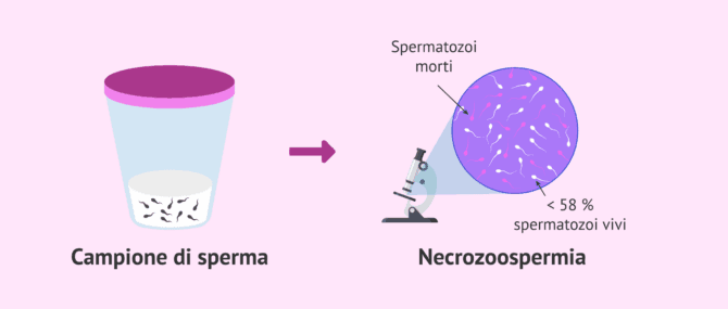 Imagen: Sterilità maschile per necrozoospermia