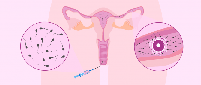 Imagen: Inseminazione artificiale intrauterina