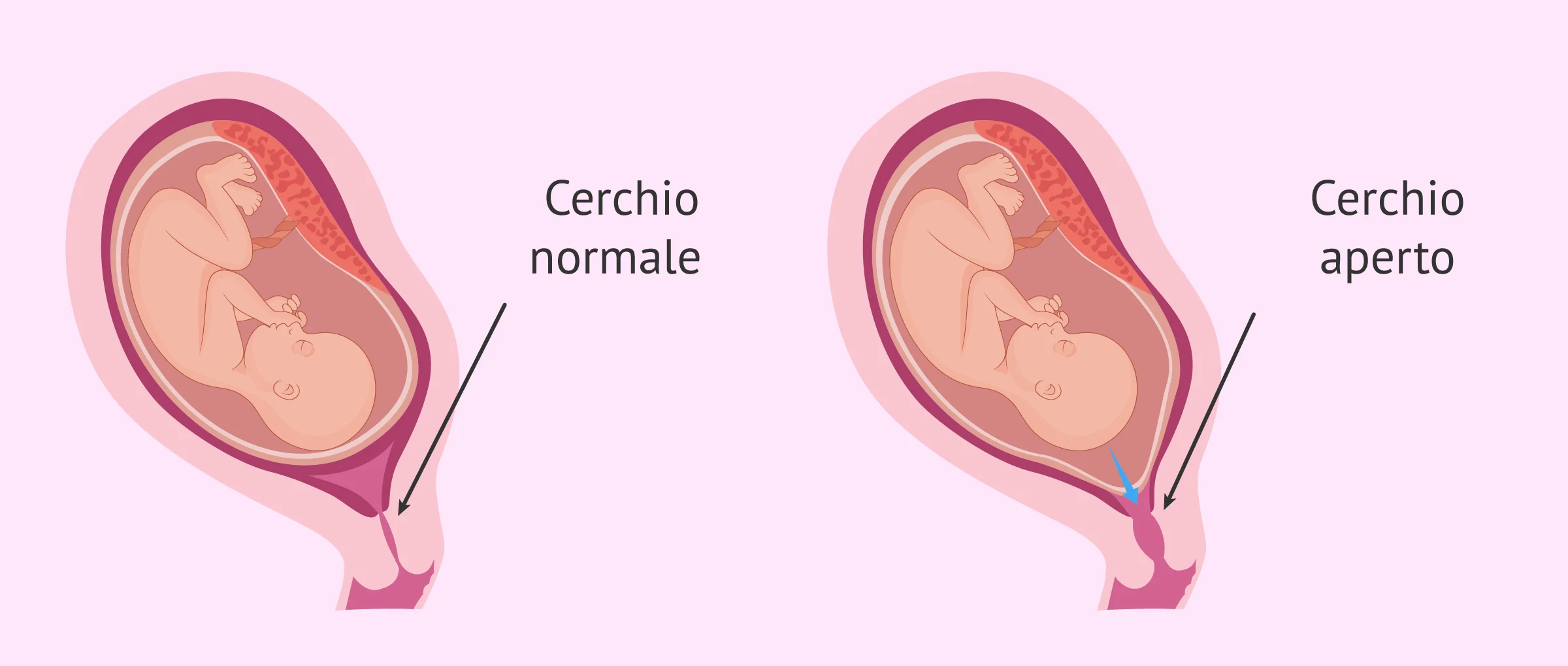 Incompetenza cervicale