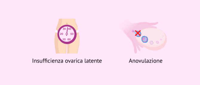 Imagen: Insufficienza ovarica e anovulazione