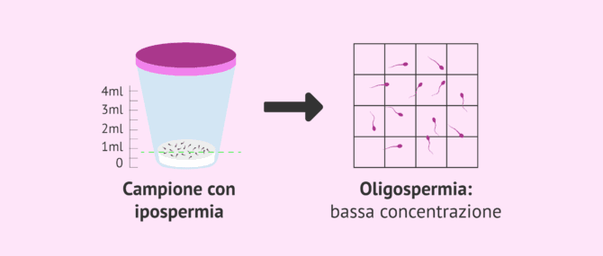 Imagen: L'ipospermia è associata all'oligozoospermia.