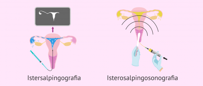Imagen: Tipi di isterosalpingografia