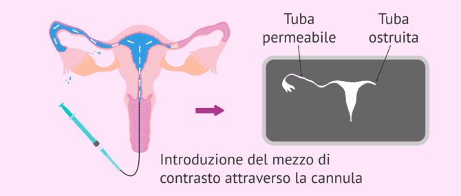 Imagen: Risultato dell'isterosalpingografia e ostruzione tubarica