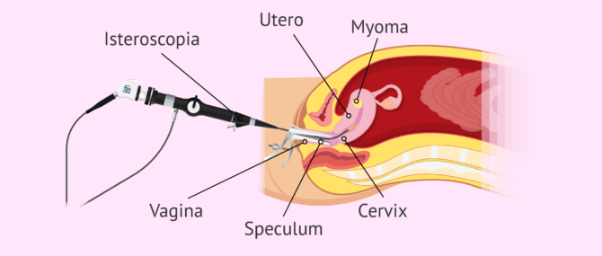 Imagen: Isteroscopia per rimuovere un mioma