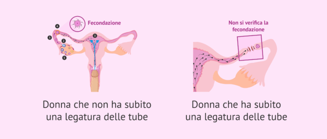 Imagen: Differenze tra una donna che ha subito una legatura delle tube e una che non l’ha subita