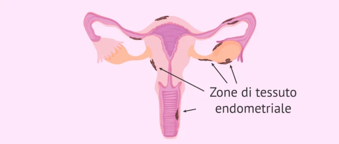 Imagen: Posizione degli impianti endometriali