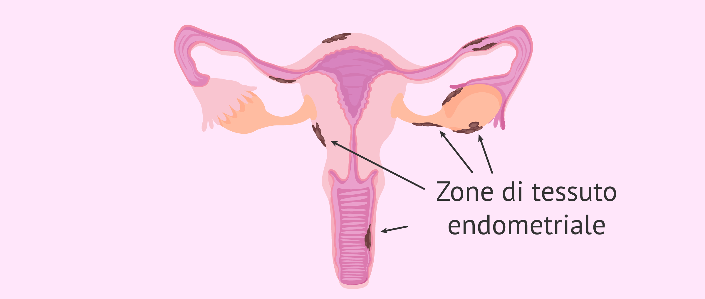 Posizione degli impianti endometriali