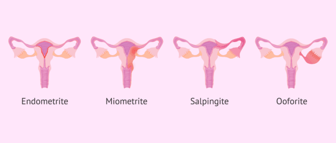 Imagen: Tipi di malattie infiammatorie pelviche (MIP)