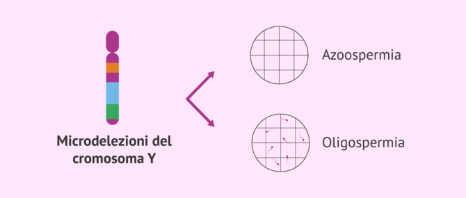 Imagen: Le microdelezioni del cromosoma Y come causa di infertilità maschile
