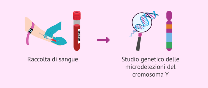 Imagen: Come vengono diagnosticate le microdelezioni del cromosoma Y?