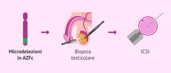 Imagen: Tecniche di riproduzione assistita con microdelezioni sul cromosoma Y