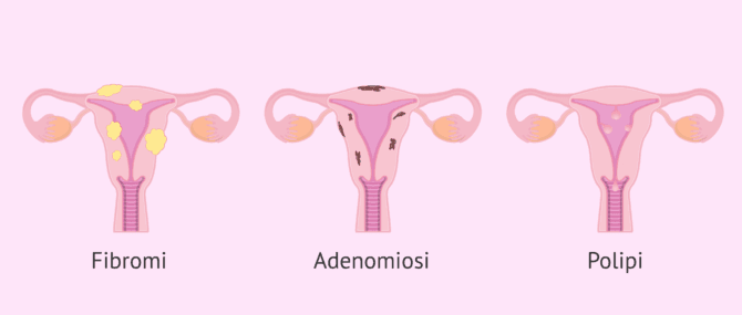 Imagen: Neoplasie dell'utero: miomi, adenomiosi e polipi