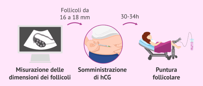 Imagen: Monitoraggio della stimolazione e programmazione del pick-up ovocitario