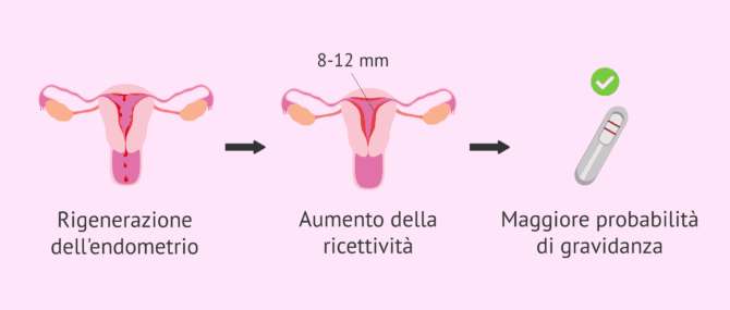 Imagen: Obiettivi dello scratching endometriale