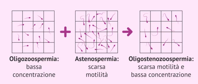 Imagen: Alterazione seminale: oligoastenozoospermia