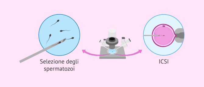 Imagen: Oligoastenoteratospermia e riproduzione assistita