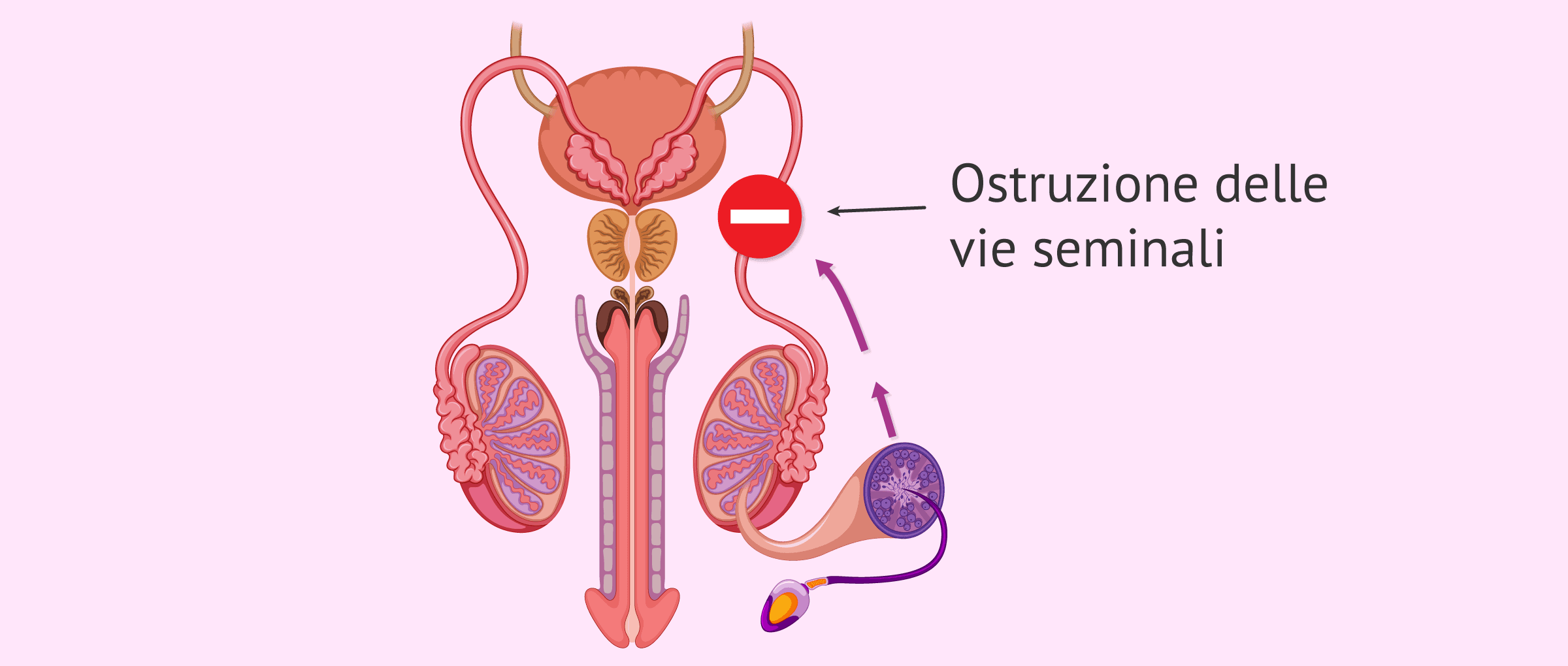 Cos'è la sterilità maschile dovuta a un fattore post-testicolare?