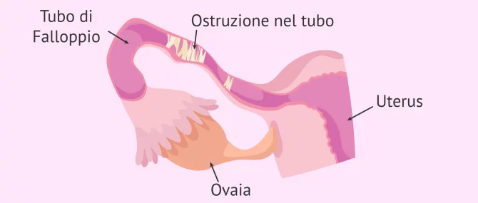 Imagen: ostruzione tubo di falloppio