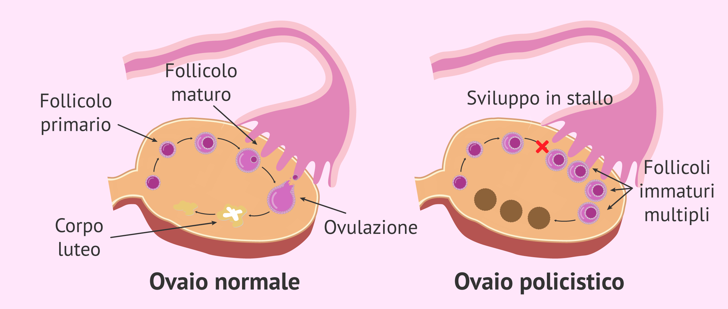 Ovaio Normale Contro Ovaio Policistico