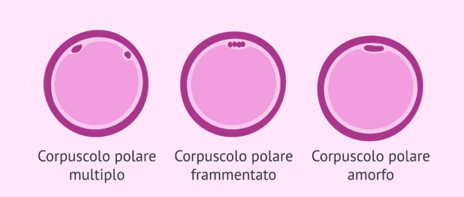 Imagen: Alterazioni del globulo polare negli ovociti