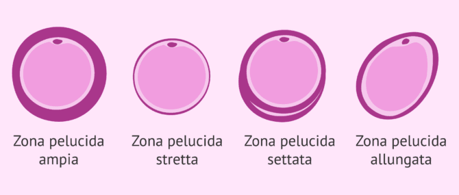 Imagen: Alterazioni della zona pellucida negli ovociti