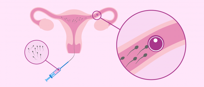 Imagen: Inseminazione delle donne per la fecondazione naturale