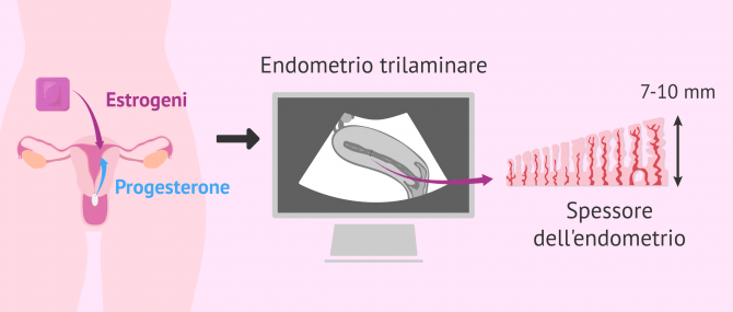 Imagen: Preparazione endometriale per il trasferimento
