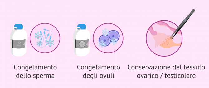 Imagen: Preservare la fertilità nei pazienti affetti da cancro