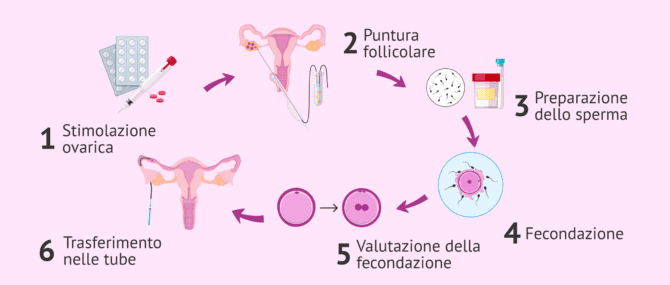 Imagen: Procedura della ZIFT