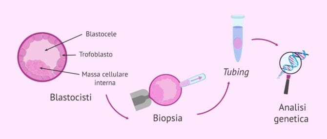 Imagen: Processo di biopsia embrionale al giorno 5