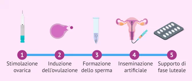 Imagen: Ciclo ovarico stimolato per l'inseminazione artificiale