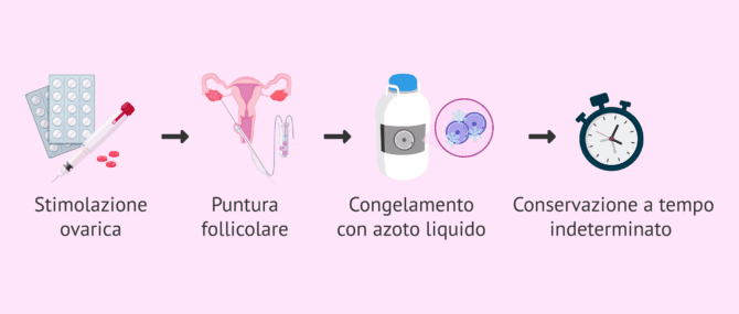 Imagen: Processo di preservazione della fertilità femminile