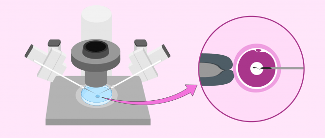 Imagen: Microiniezione di sperma nell'ovulo