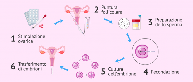 Imagen: Processo di fecondazione in vitro