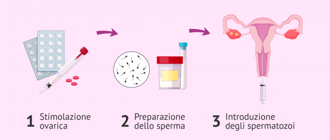 Imagen: Inseminazione artificiale intrauterina