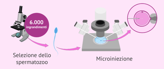 Imagen: Microiniezione con IMSI