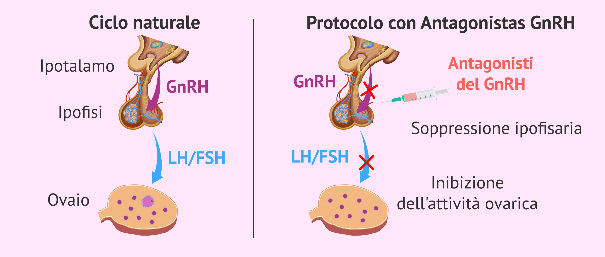 Cos'è un breve protocollo di FIV con gli antagonisti di GnRH?