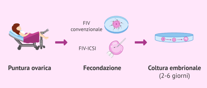 Imagen: Puntura ovarica e giorno 0 dello sviluppo embrionale