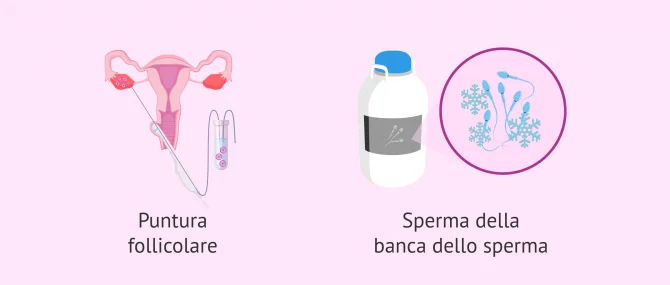 Imagen: Puntura follicolare e capacitazione dello sperma