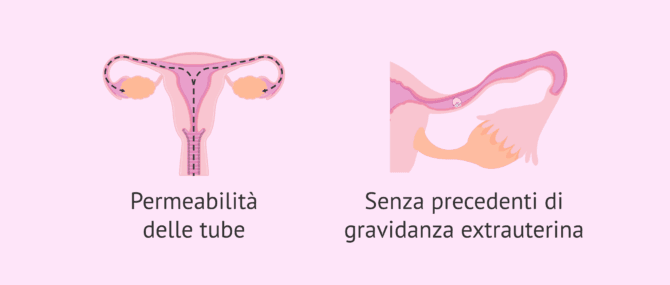 Imagen: Requisiti per una ZIFT