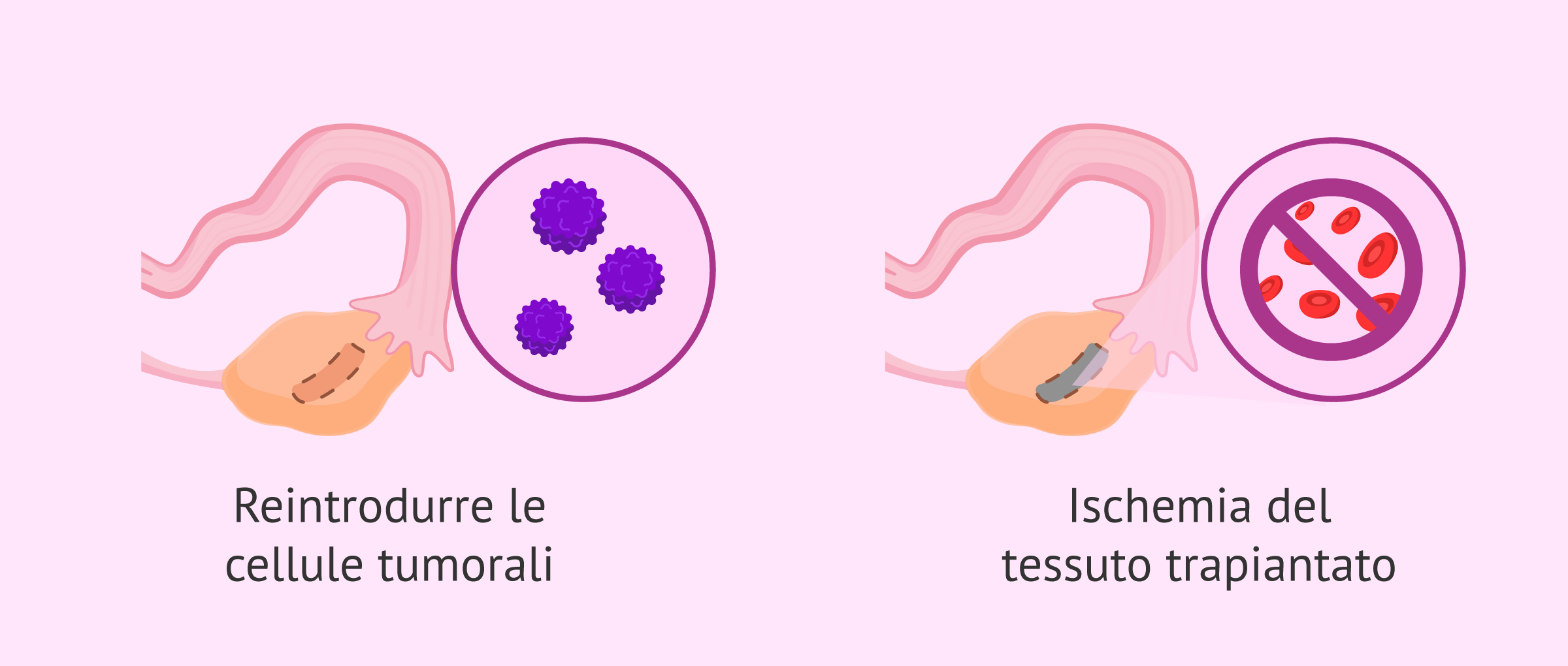 Limitazioni del trapianto di tessuto ovarico