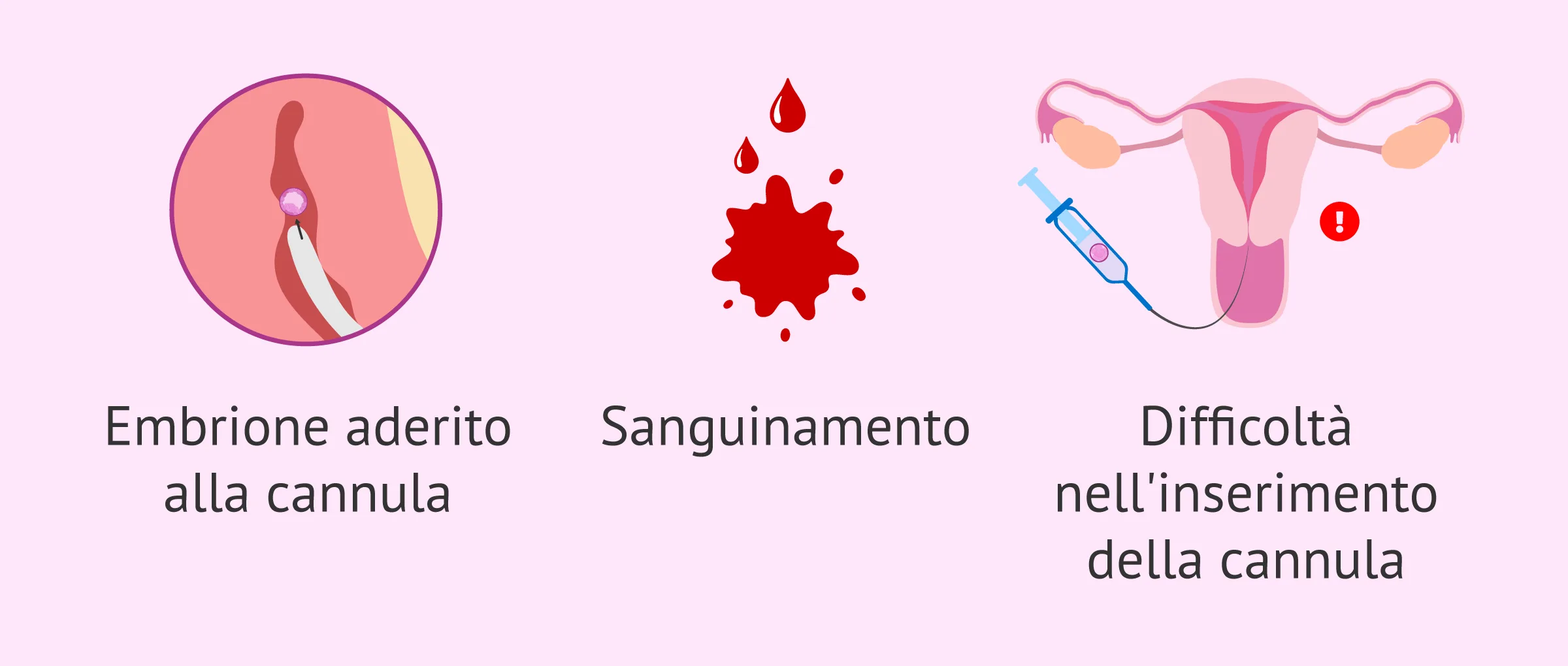 Quali sono i rischi della gravidanza tramite ovodonazione?