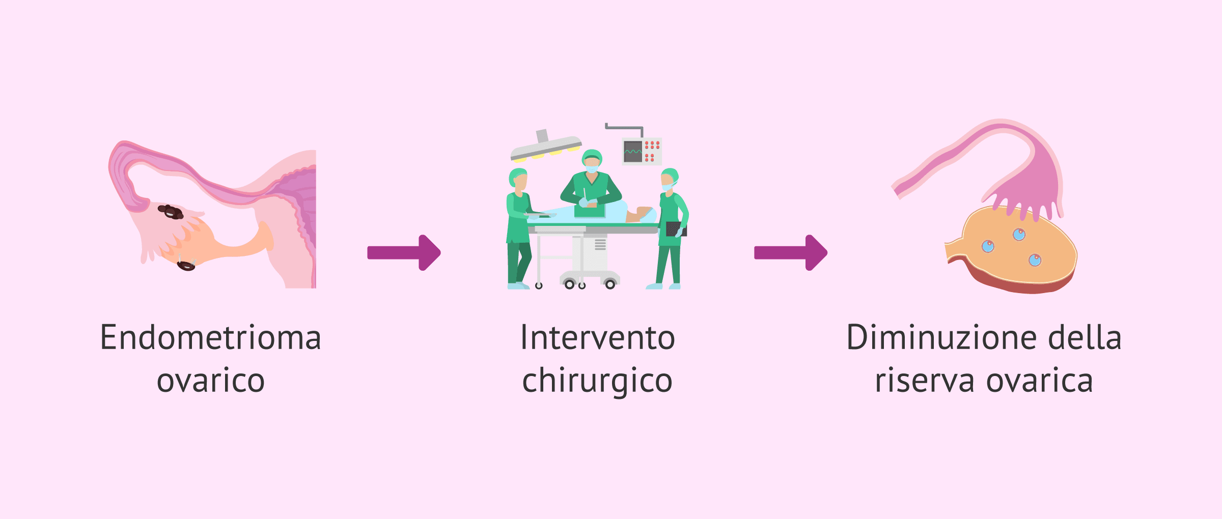 Chirurgia dell'endometrioma: tecniche che preservano la riserva ovarica