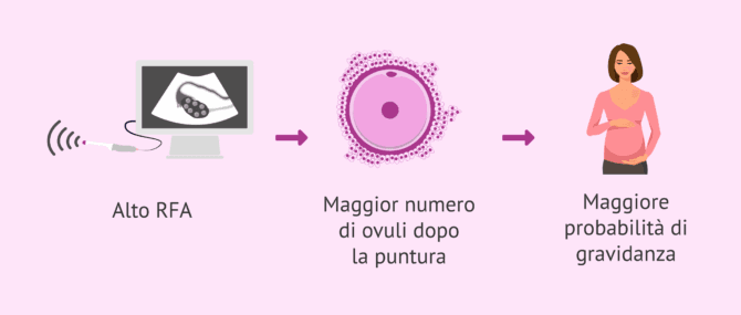 Imagen: Riserva ovarica e risultati nella riproduzione assistita