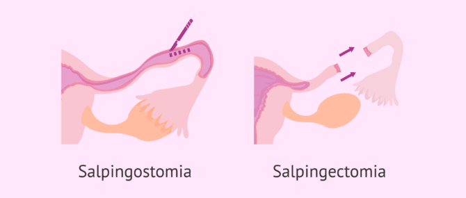 Imagen: Salpingostomia e salpingectomia per il trattamento della gravidanza ectopica