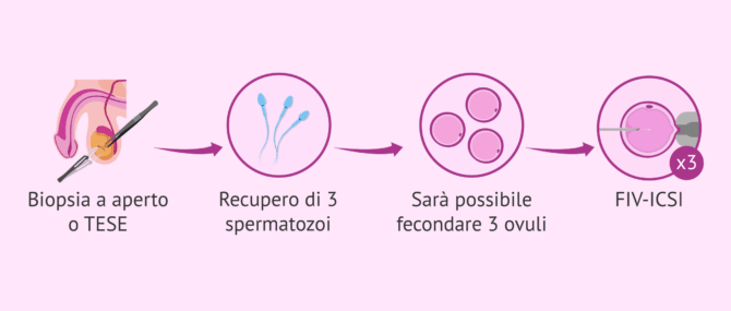 Imagen: Biopsia testicolare e ICSI per ottenere una gravidanza