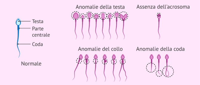 Imagen: Cos'è uno spermatozoo anomalo?