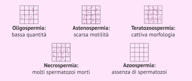 Imagen: Sperma causa di infertilità maschile