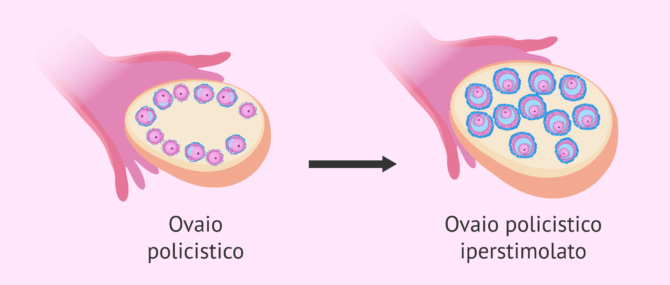 Imagen: Iperstimolazione ovarica con PCOS