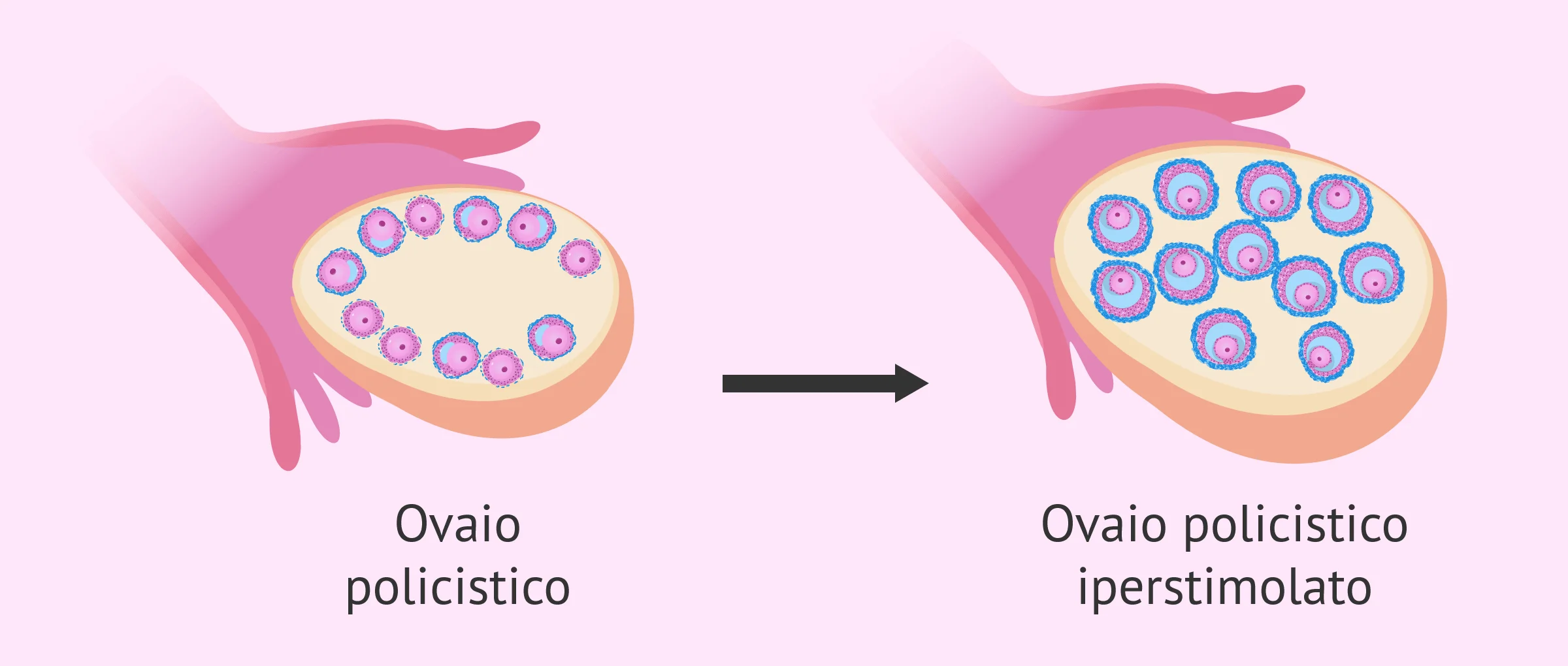 Iperstimolazione ovarica con PCOS